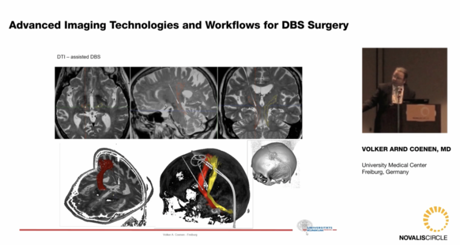 Advanced Imaging Technologies and Workflows for DBS Surgery