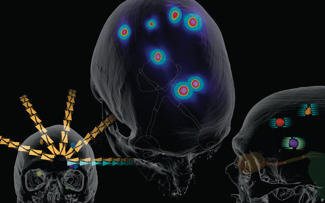 Clinical Validation: Elements Multiple Brain Mets SRS by Brainlab