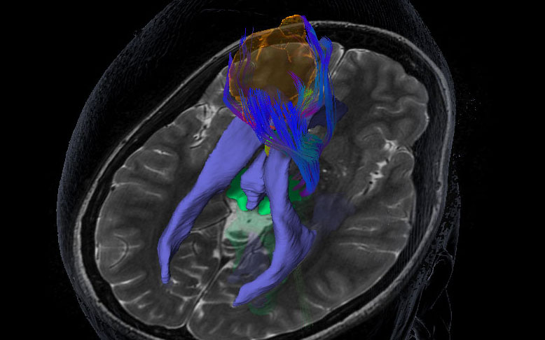 Novalis Circle Symposium: Neurosurgery Developments in the Treatment of High-Grade Gliomas